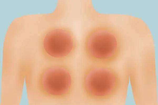 拔罐为啥不好 ab955b0477af4c0a869c97f3657e1b5f.jpeg