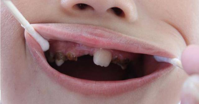 孩子：父母做好这5点，孩子才能拥有健康好牙3岁儿童一半被龋齿困扰