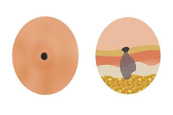 怎么才能不长黑痣 0b32d2a216d04c9fad3578bd1155581e.jpeg