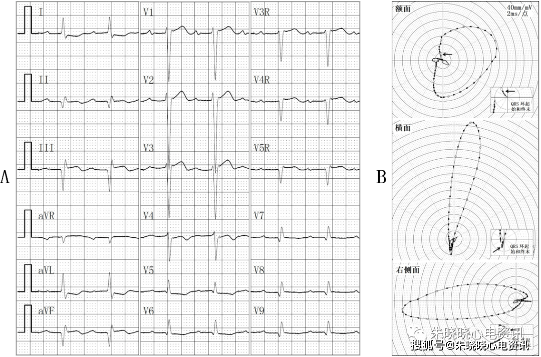 罗昭林老师:心电向量图对心电图上不典型心肌梗死q波的鉴别作用