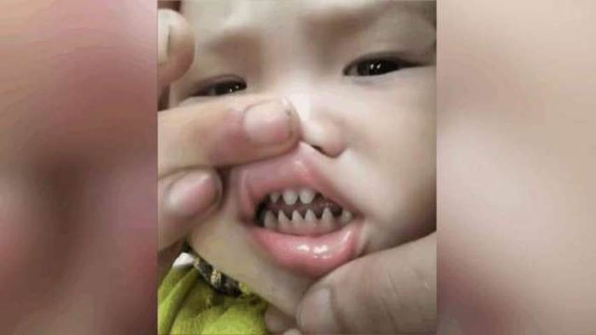 不怕孩子牙齿不齐，就怕“鲨鱼牙”，医生说很多孩子都有这种行为