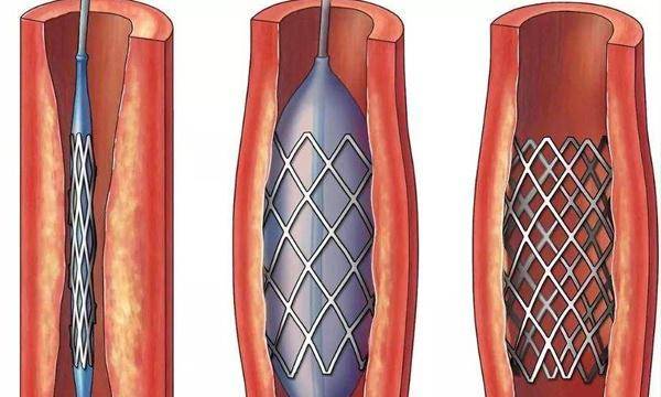 原创心脏支架是什么?做了支架手术后,如何保养?为了身边人看一下