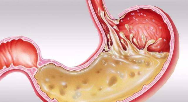 胃酸多吃什么药最快好 fc02c5dfdb134ae7b981f8de9c4a4a83.jpeg