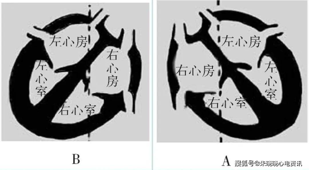 镜像右位心的 f 导联心电图特征读析