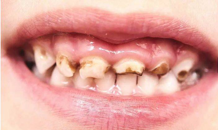 儿童牙齿腐烂的症状通常与成人相同,但也可能包括牙龈肿胀,烦躁不安和