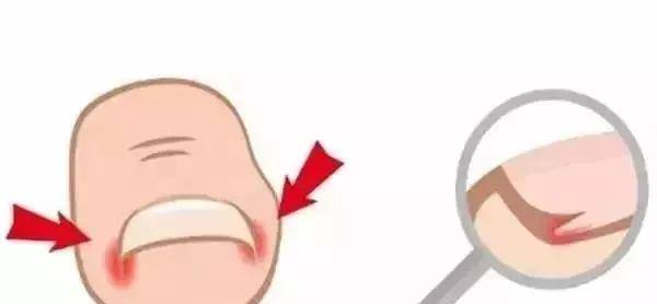 甲沟炎可以彻底治愈吗 d6f23154ef6e4a31a9180d64e1255a16.jpeg