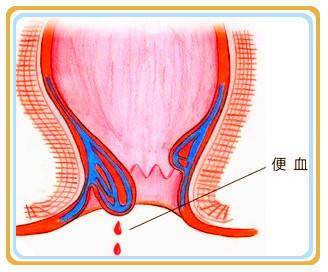 医生提醒血便不一定是痔疮大肠肿瘤要慎防