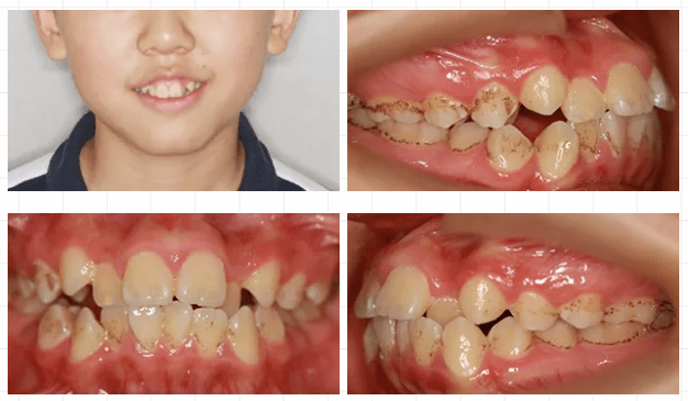 矫正牙齿医院排名_去医院矫正牙齿(2)
