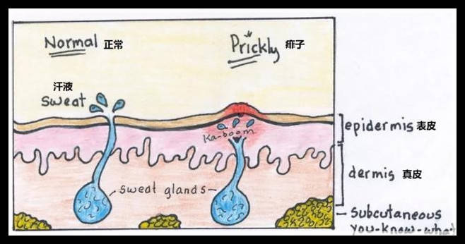 『护理』干货！宝宝长痱子怎么办？“对症护理”帮助宝宝轻松过夏天