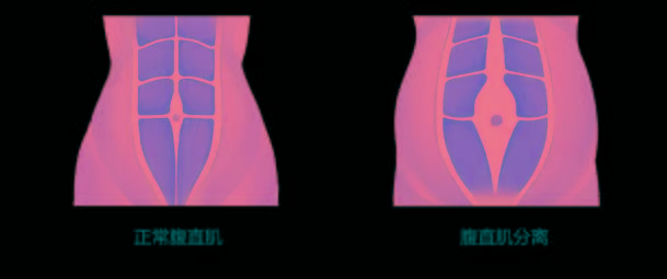 孕期时两侧的腹直肌从中间腹白线的位置逐渐向两侧拉伸,产后腹壁松弛