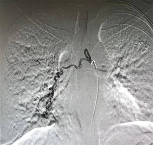 宁夏第四人民医院成功开展3例支气管动脉栓塞术