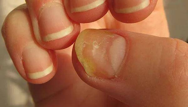 有的人指甲表面凹凸不平,并伴随着指甲发黄,增厚则说明感染上了灰指甲
