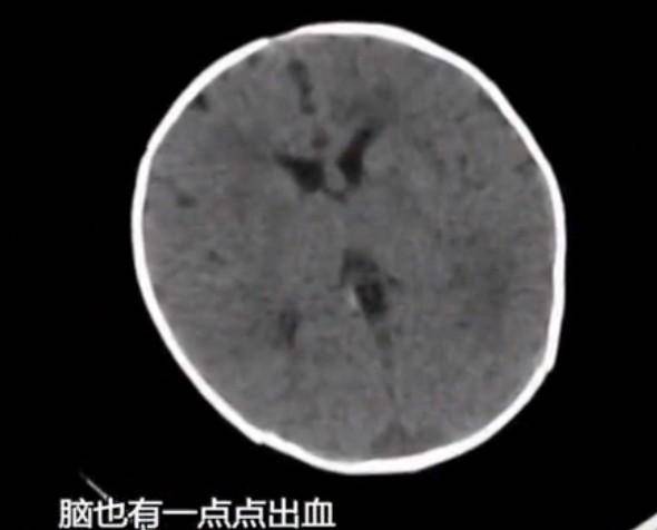 婴儿|医生：和妈妈坐月子中这个习惯有关2月龄婴儿突发脑出血