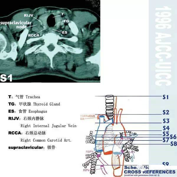 今日分享 — 纵隔淋巴结分区图谱
