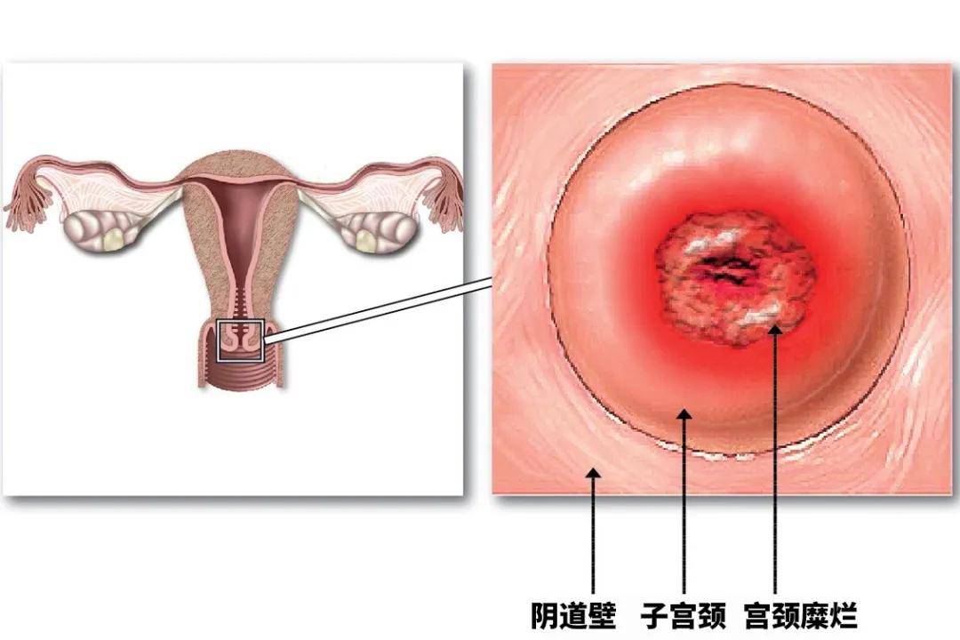 医生说  "宫颈糜烂" 大部分属于正常的生理现象,需要结合宫颈细胞学