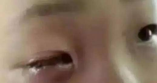 眼球|家长千万要警惕！20分钟孩子眼球被溶化！这东西每家都有