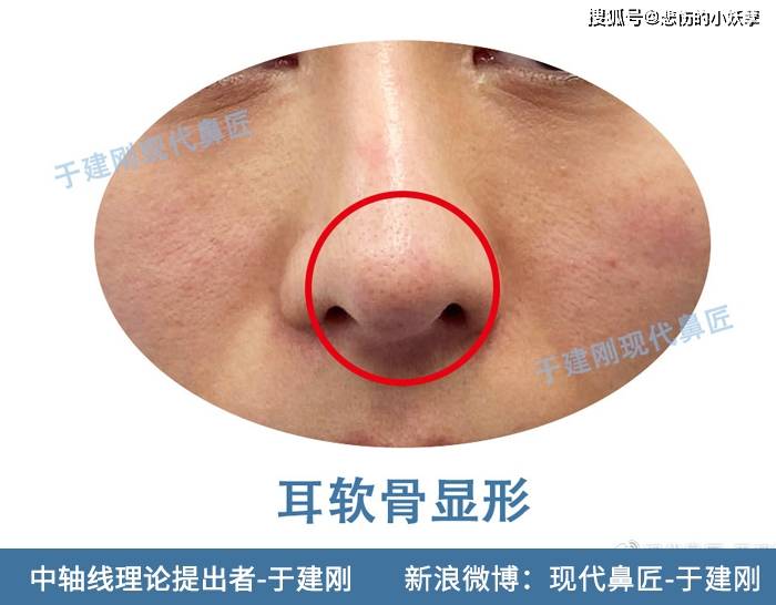 现代鼻匠于建刚说鼻|鼻整形后假体外露怎么办?