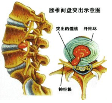 很多时候腰疼可能是腰肌劳损,腰背肌筋膜炎,腰椎小关节突功能紊乱