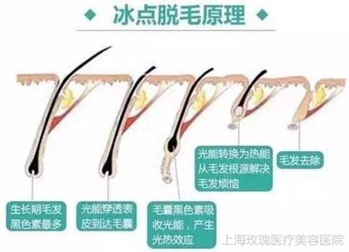 冰点激光脱毛的原理_冰点激光脱毛原理:   冰点激光脱毛,是利用冰点激光深入毛囊组织,激光可