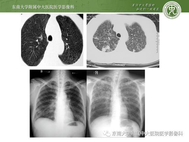 肺结核影像鉴别与表现