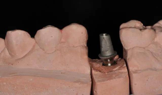 基台 牙冠颊侧照种植戴牙 嵌体牙体预备颌面照嵌体戴修复体咬颌照修复