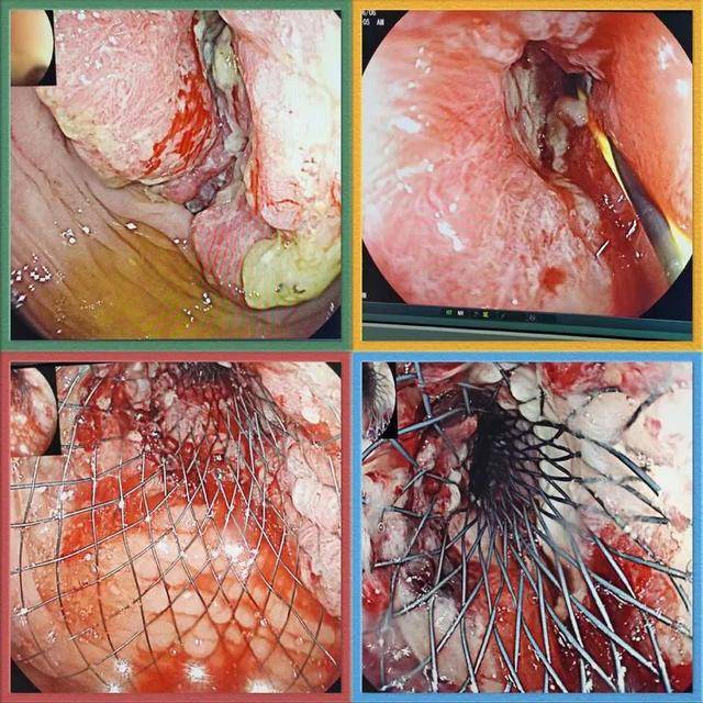 吕梁市中医院内镜室-肠道支架,再通生命之道_肿瘤