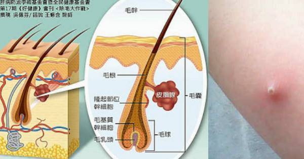 青春痘和毛囊炎一样?这4大区别一定要了解.