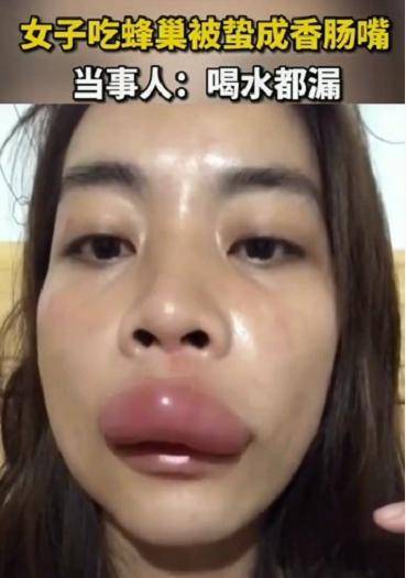 原创网红直播吃蜂巢被蛰成香肠嘴,喝水都漏,网友:电影里香肠嘴是真的!