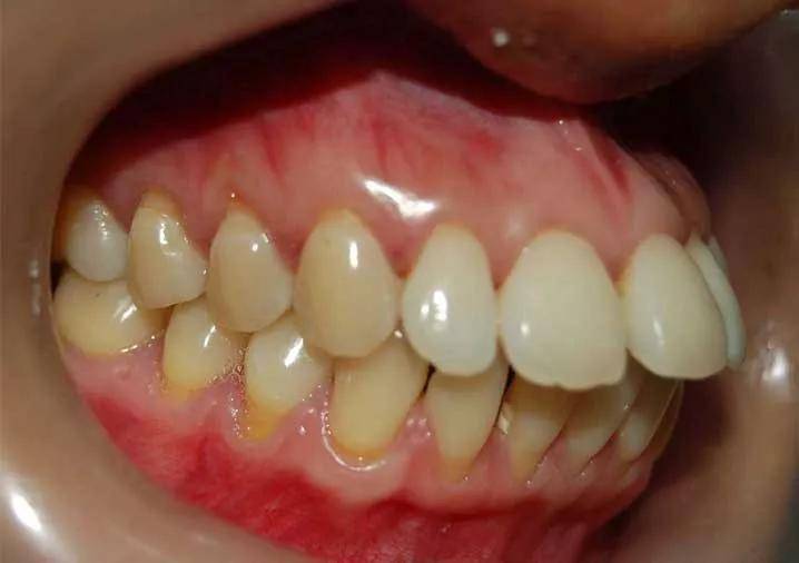 经常性咬下嘴唇,可能会导致上前牙舌侧压力过大而使上前牙前突,下颌