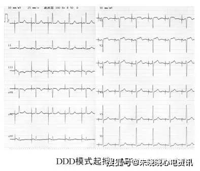 ①起搏时,每个心脏除极波(p波或qrs波)前均有一个脉冲钉信号; ②感知