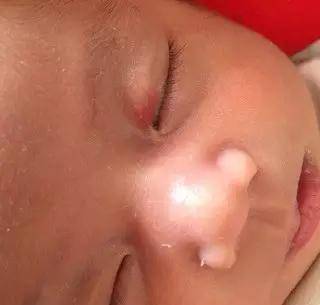 孩子各种胎记、血管瘤、斑、痣全面分析！