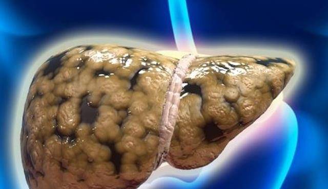 喝什么降脂肪肝最快最好 77f21690fbaf47fc8a3feeff1cee1ace.jpeg