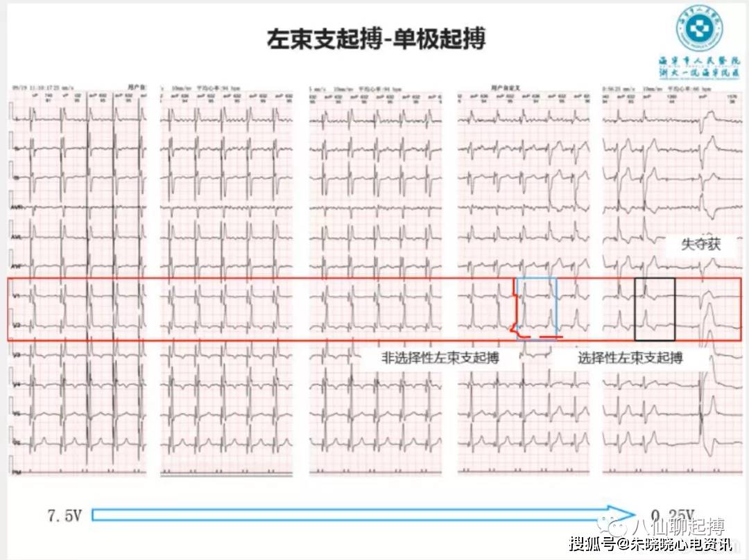 吉亚军老师左束支起搏心电图分析