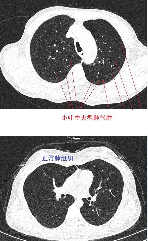 经典图谱 实战图谱,一文看懂肺气肿!