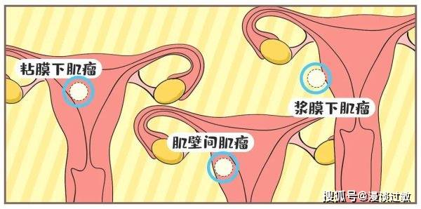 的常见良性肿瘤 肌瘤按照生长部位 可以分为 子宫体肌瘤和子宫颈肌瘤