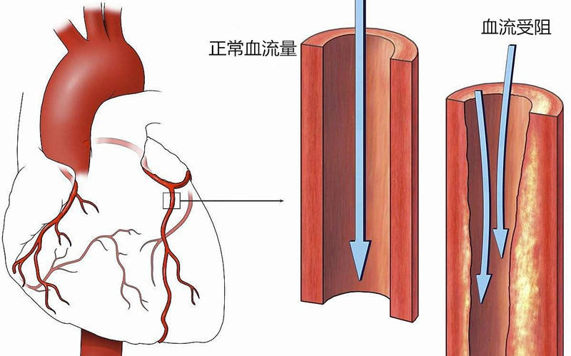 除了以上提到的影响因素,还有研究发现冠状动脉慢血流与冠状动脉扭曲