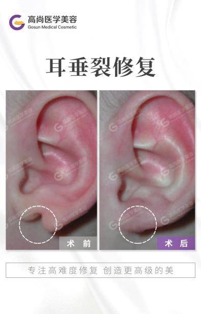 耳垂通过手术整形可以吗?余文林解答
