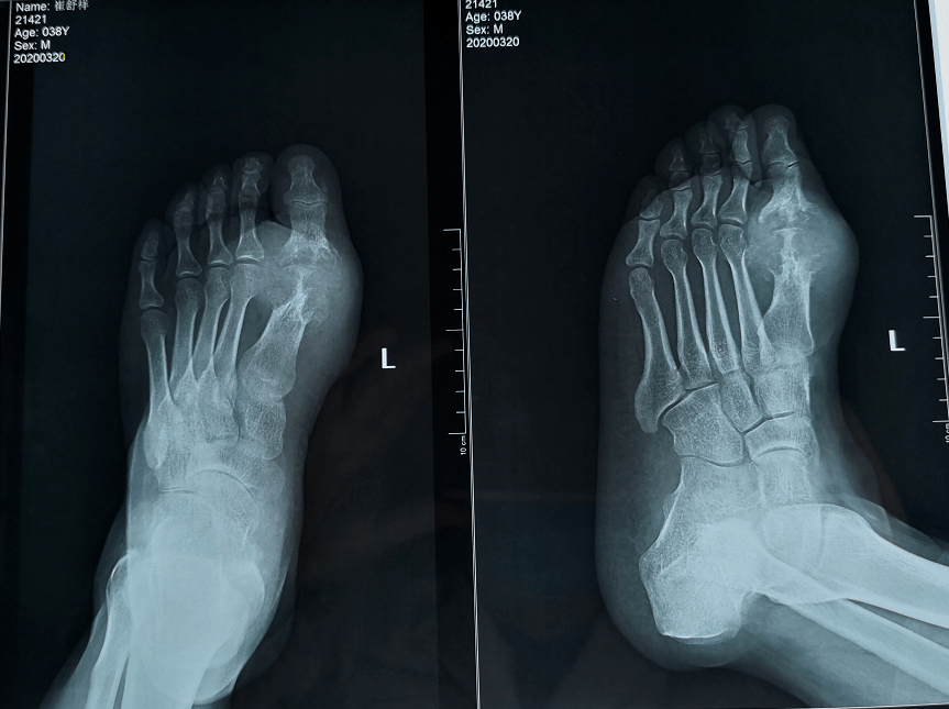 患者dr片提示:双足第一及第1趾骨近节趾骨骨质破坏