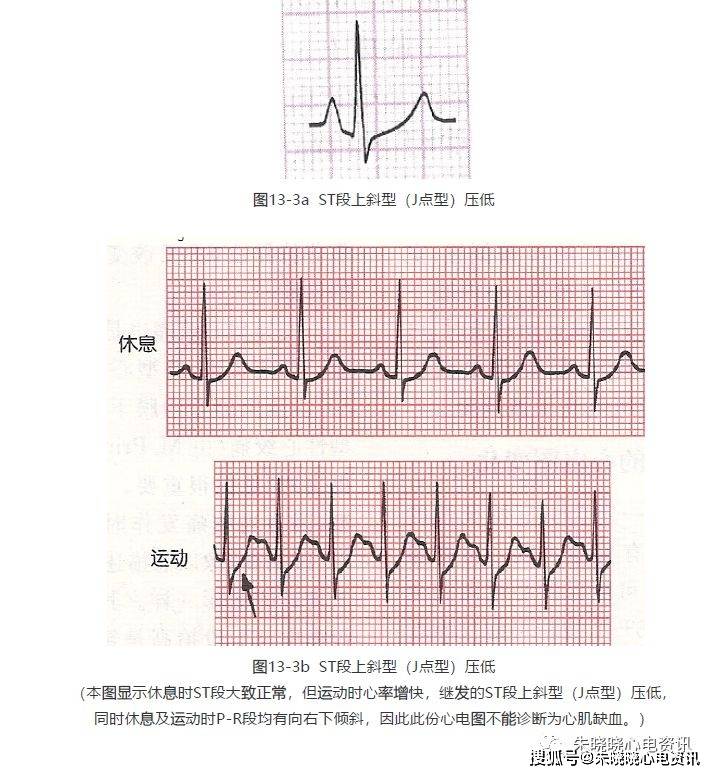 一般来说,j点型st段压低的临床意义较小,常为生理性的,特别是在心动过