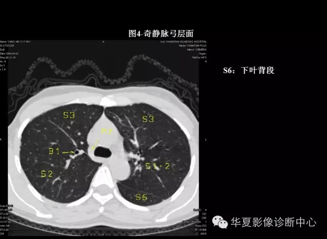 肺段ct解剖,终于搞清楚了!