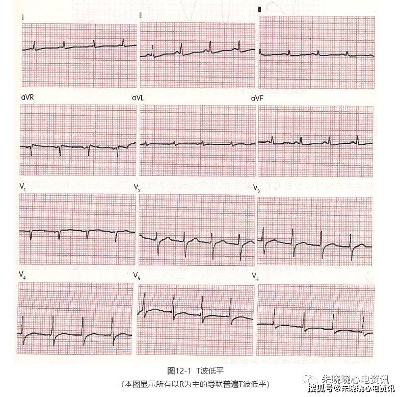 第十二讲:t波改变与心肌缺血_心电图