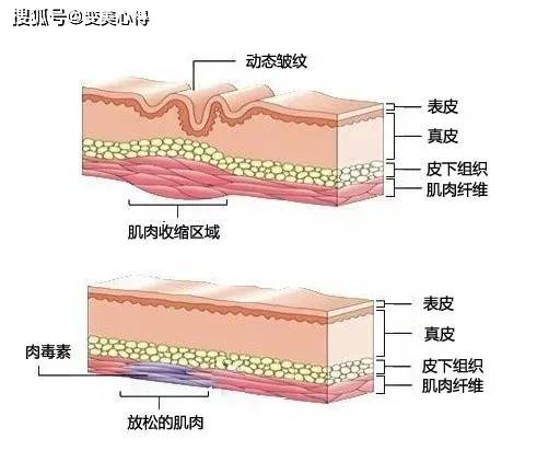 打瘦脸针失败怎么办