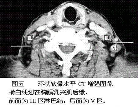 解剖颈部淋巴结分区精选资源
