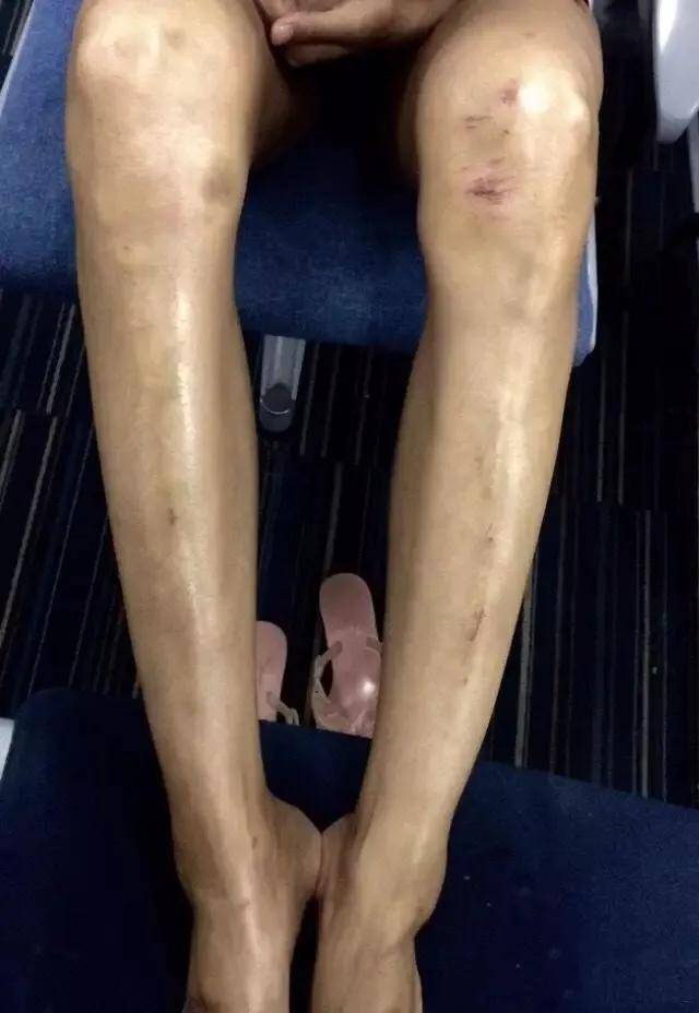 受伤|张蓝心拍戏头部受伤，头裹纱布满身血迹，为赶进度拒绝缝针