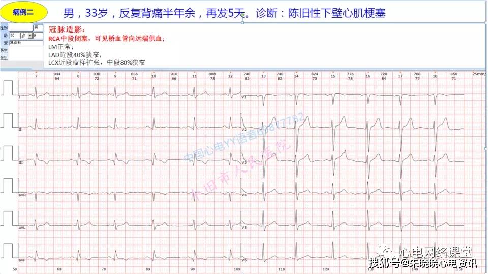 不典型心肌梗死的心电图改变