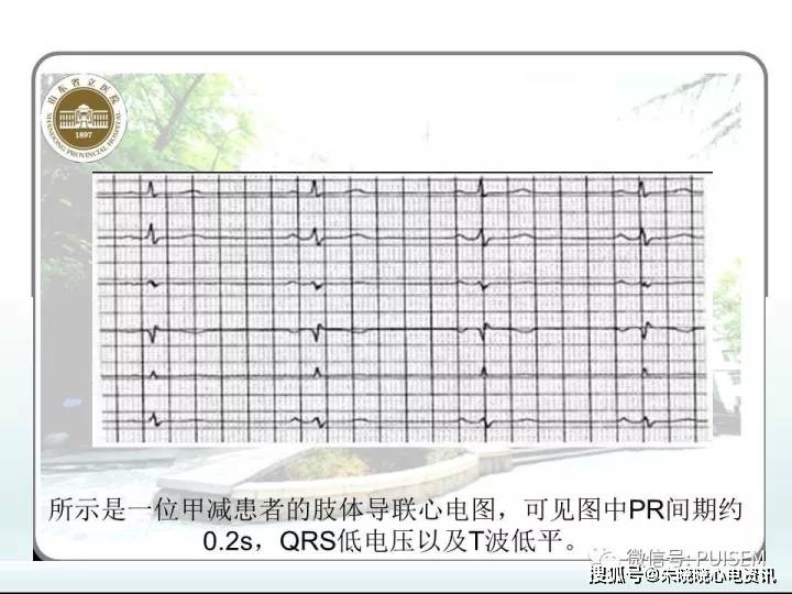 非心脏病的心电图异常