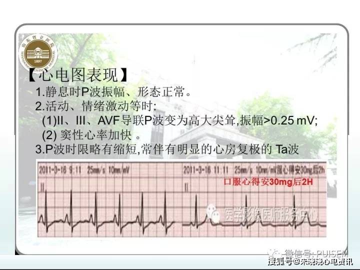 非心脏病的心电图异常