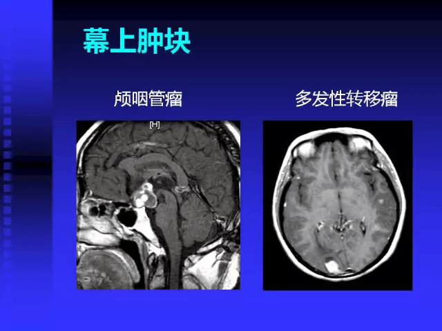 mr入门 | 头颅mri读片知识,需掌握!