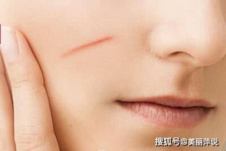 怎么去掉旧伤疤，这五个去烫伤疤痕的方法
