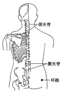 腰椎间盘突出重点涂抹飞天艾灸液穴位有:腰夹脊,腰阳关,殷门穴,委中